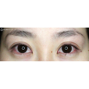 症例写真 術後 二重術・目頭切開・涙袋・眼瞼下垂
