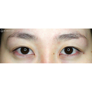 症例写真 術前 二重術・目頭切開・涙袋・眼瞼下垂