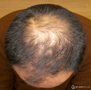 症例写真 術前 プレミアム・グロースファクター毛髪再生療法＋外用と内服薬