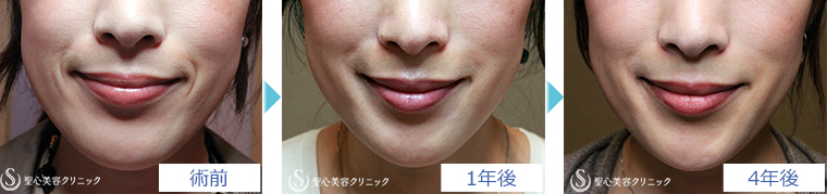 術後の経過写真 若返り・アンチエイジング