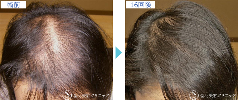 症例写真 術前術後比較 毛髪再生療法