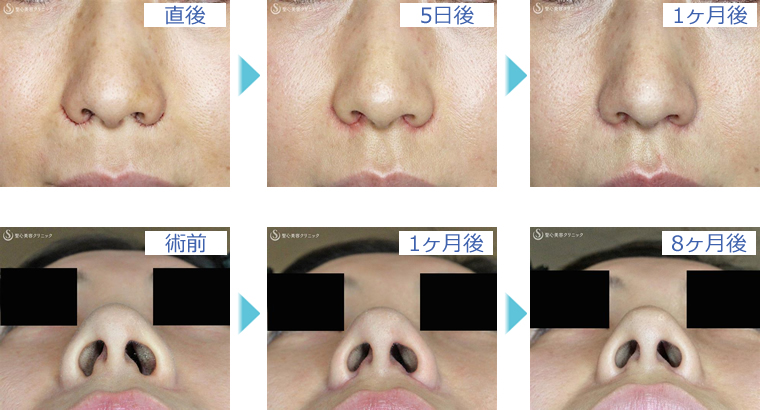 症例写真 術前後比較 鼻の整形