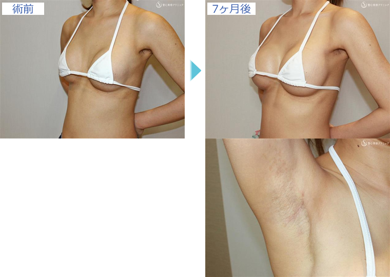 症例写真 術前術後比較 バッグプロテーゼ豊胸術