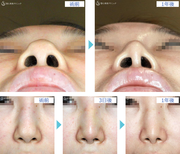 症例写真 術前後比較 鼻の整形