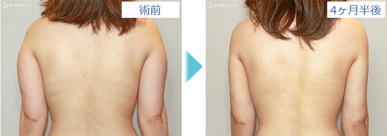 症例写真 術前術後比較 ベイザーリポ2.2脂肪吸引 二の腕