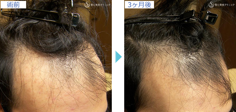 症例写真 術前術後比較 毛髪再生療法