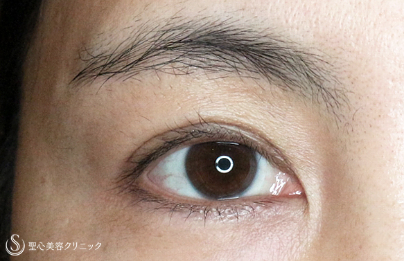 目のクマ くぼみ たるみ 三角目 の症例写真 聖心美容クリニック札幌院