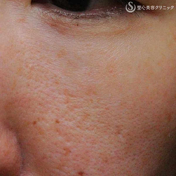 症例写真 術後 美容皮膚科 ほくろ・イボ除去