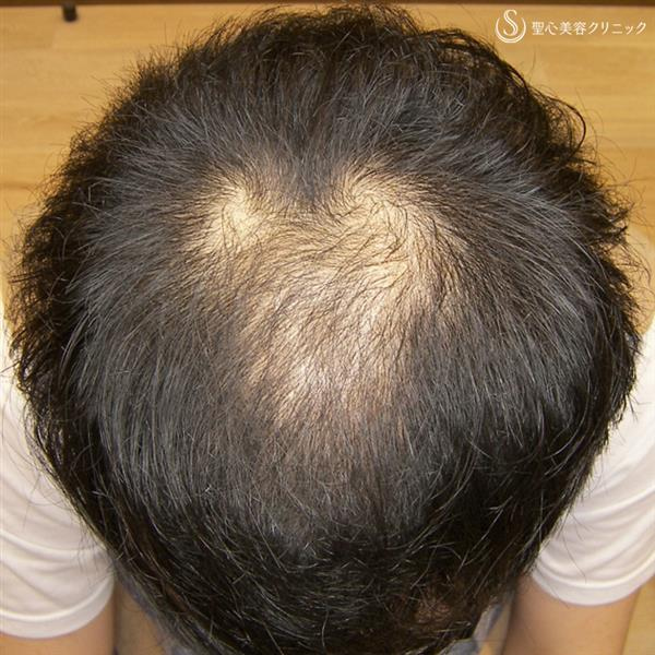症例写真 術前 毛髪再生療法 グロースファクター再生療法