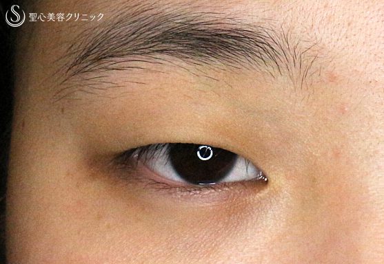 症例写真 術前 二重術・目頭切開・涙袋