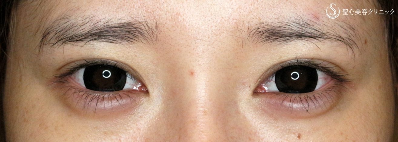 症例写真 術後 切らない眼瞼下垂+α法、マイクロメソッド+α、涙袋形成