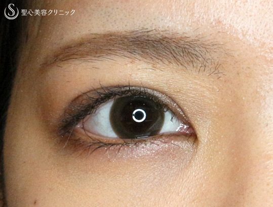 症例写真 術後 二重術・目頭切開・涙袋