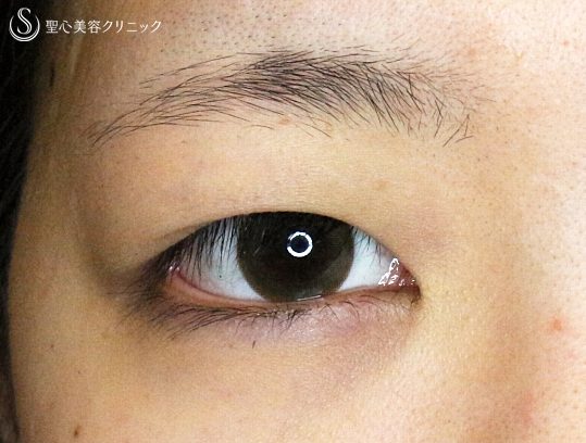 症例写真 術前 二重術・目頭切開・涙袋