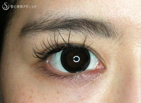 二重術 目頭切開 涙袋 眼瞼下垂の症例写真 聖心美容クリニック札幌院 二重術 目頭切開 涙袋 眼瞼下垂の症例写真 聖心美容クリニック札幌院