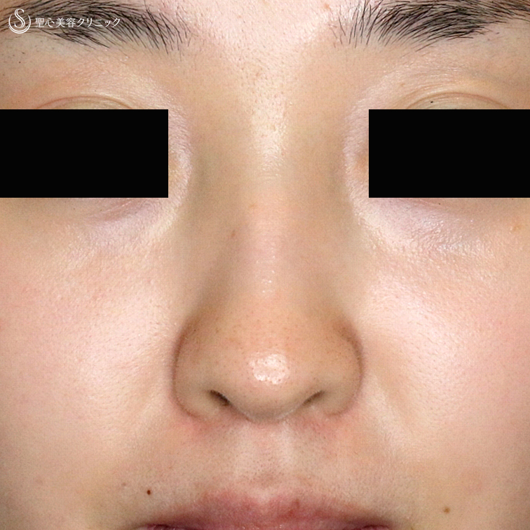 鼻の整形の症例写真 聖心美容クリニック札幌院
