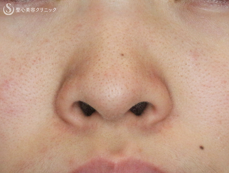 鼻の整形 小鼻 の症例写真 聖心美容クリニック札幌院
