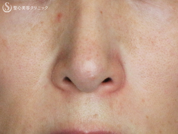 美容皮膚科 赤ら顔 血管の浮き の症例写真 聖心美容クリニック札幌院