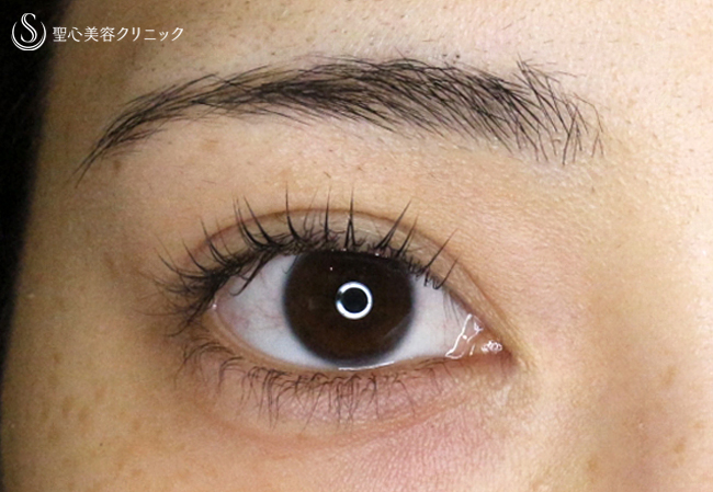 二重全切開+α法（札幌院独自メニュー）＋目頭切開+α法（札幌院独自メニュー）_After