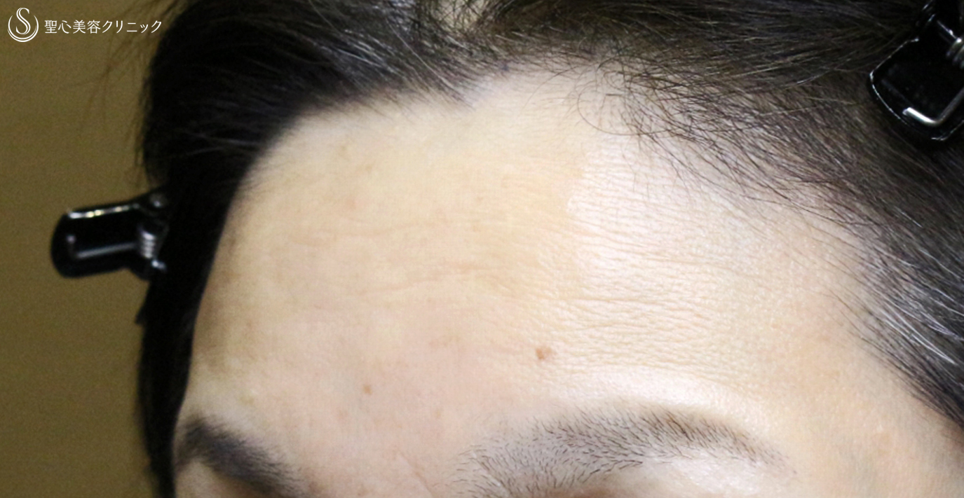 プレミアムPRP皮膚再生療法_After