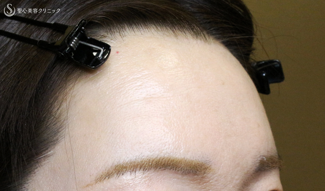 プレミアムPRP皮膚再生療法_After