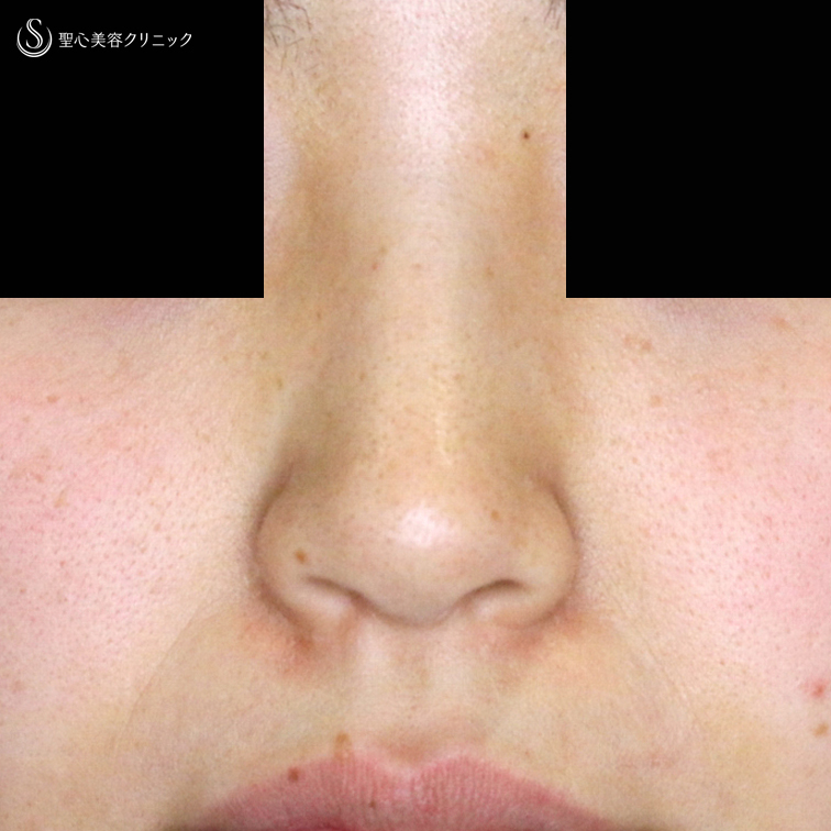 小鼻縮小術+α法_After
