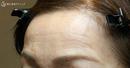 症例写真 術前 若返り・アンチエイジング