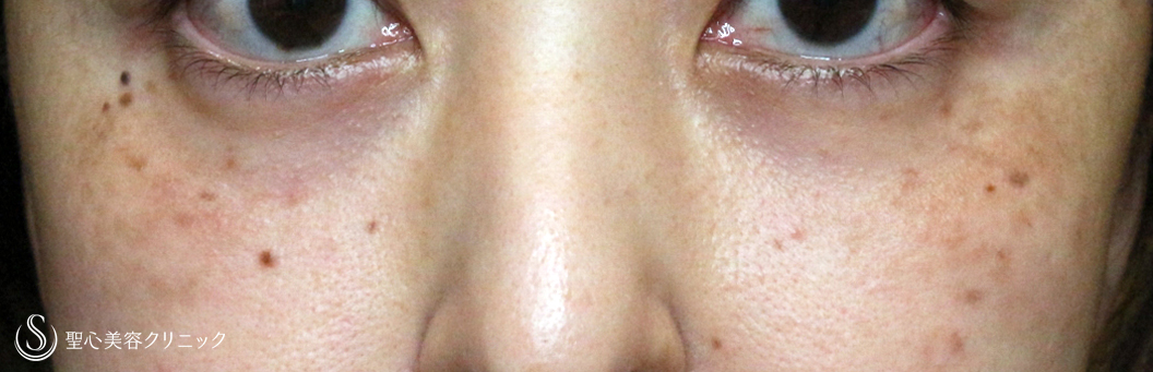 目の下の脂肪取り（経結膜下脱脂法）_After