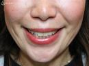 症例写真 術後 若返り・アンチエイジング