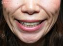 症例写真 術前 若返り・アンチエイジング