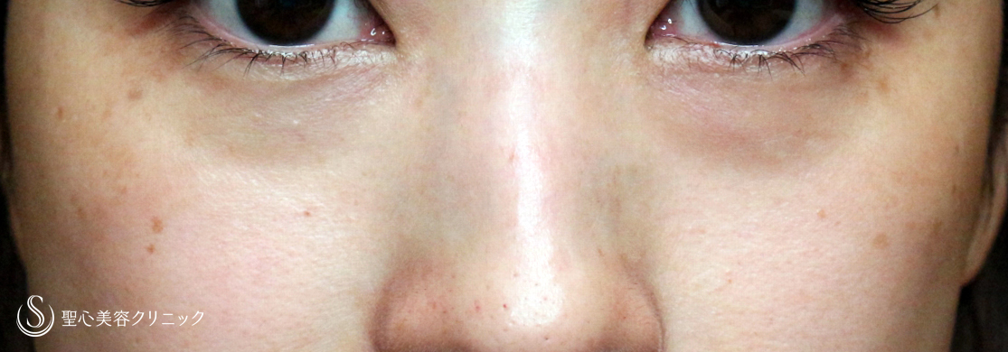 目の下の脂肪取り（経結膜下脱脂法）_Before