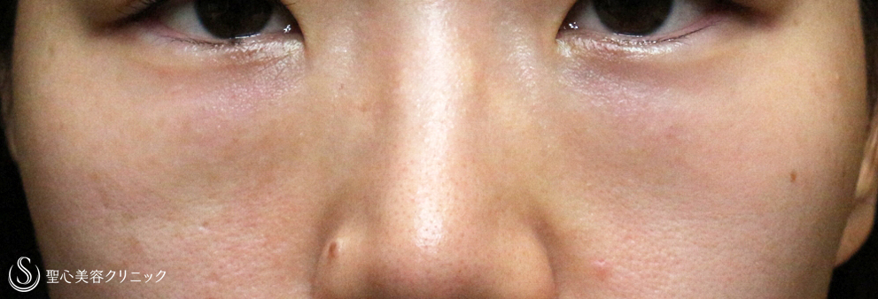 目の下の脂肪取り（経結膜下脱脂法）_Before