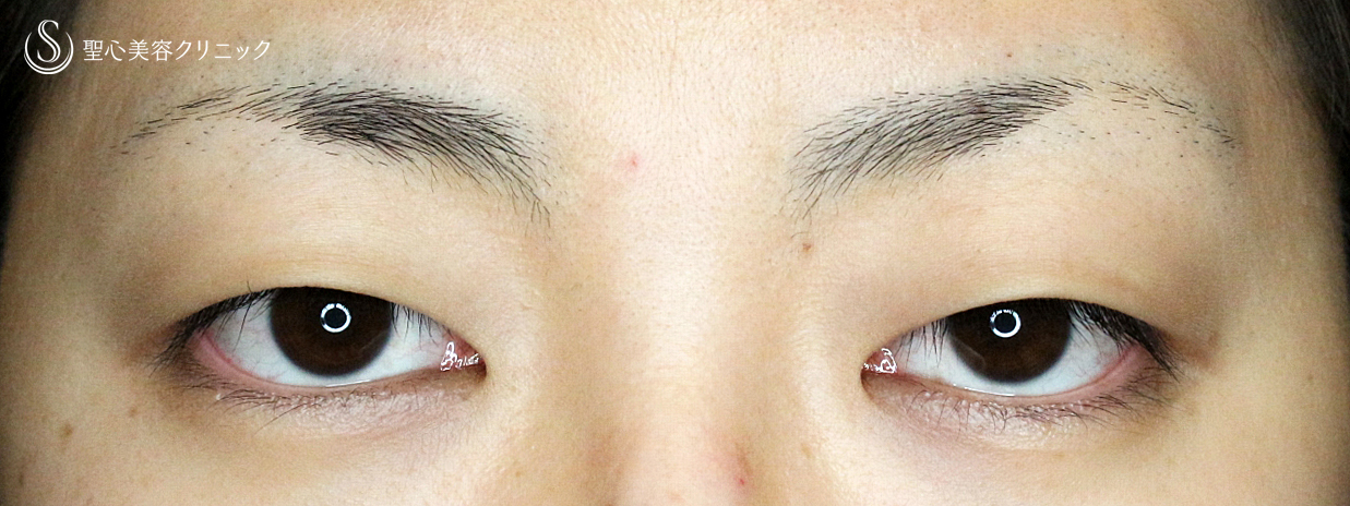 切らない眼瞼下垂+α法（札幌院独自メニュー）_Before
