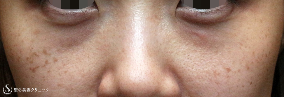 目の下の脂肪取り（経結膜下脱脂法）+プレミアムPRP皮膚再生療法_Before