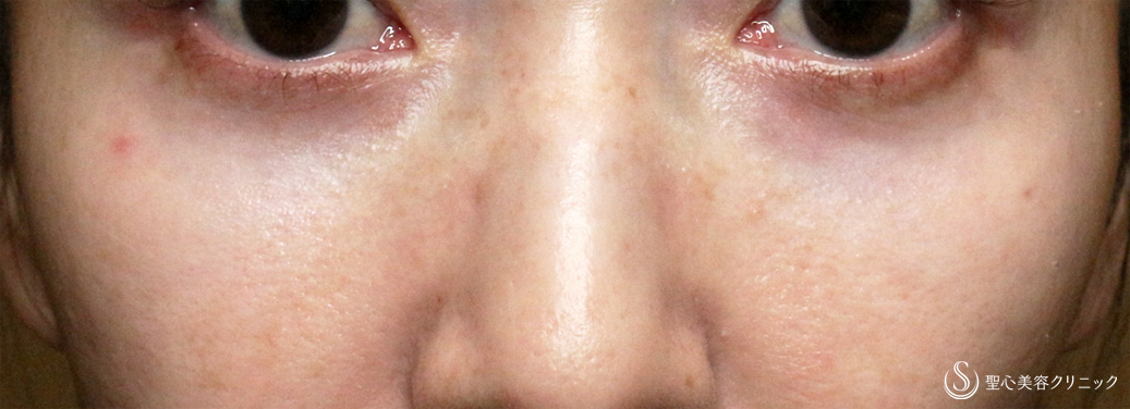 目の下の脂肪取り（経結膜下脱脂法）_After