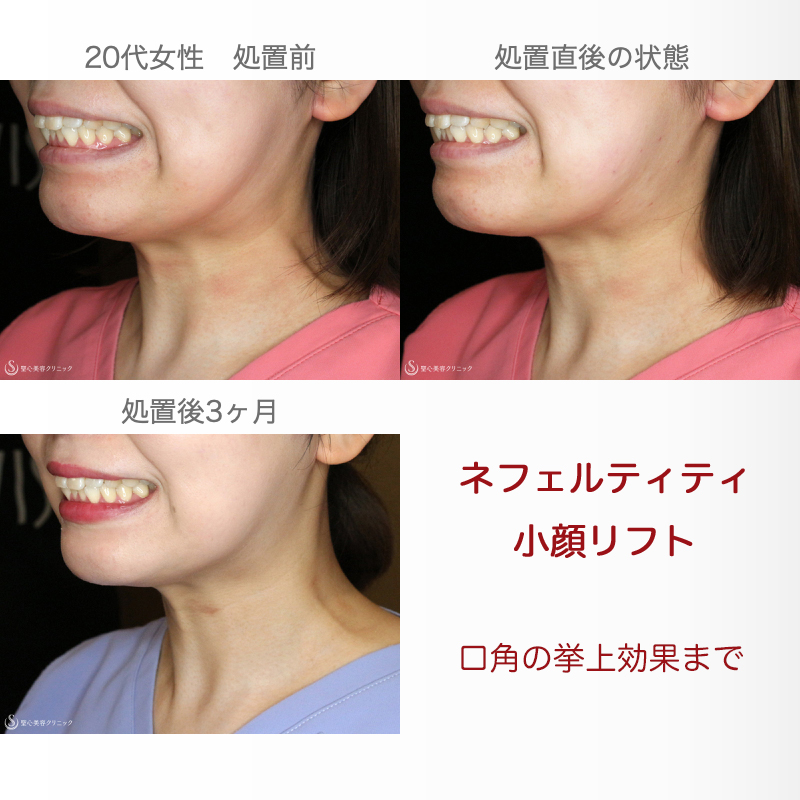 ネフェルティティリフト_After