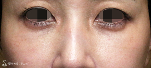 目の下の脂肪取り（経結膜下脱脂法）＋プレミアムPRP皮膚再生療法＋ヒアルロニダーゼ_After
