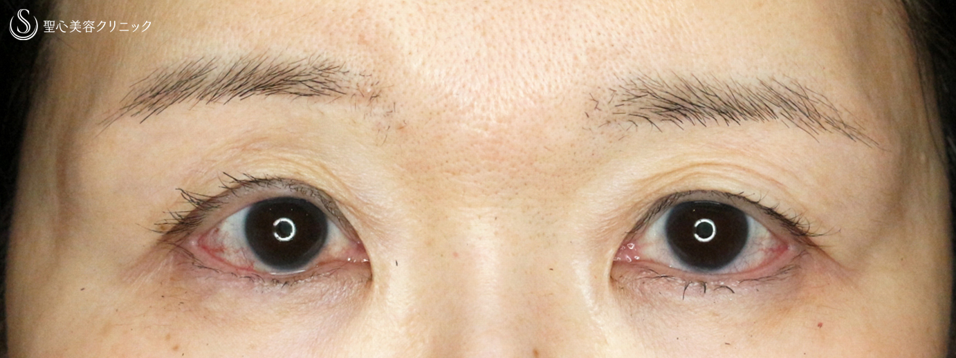 症例写真 術後 切らない眼瞼下垂+α法＆眉下リフト
