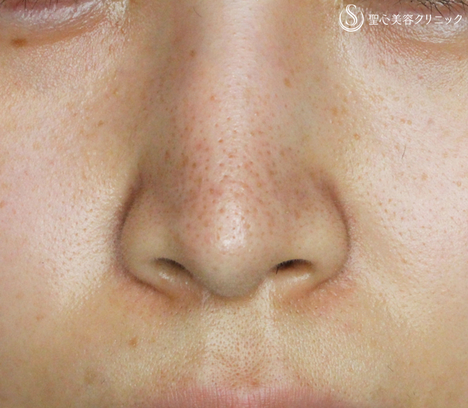 症例写真 術前 プロテーゼによる隆鼻術+小鼻縮小