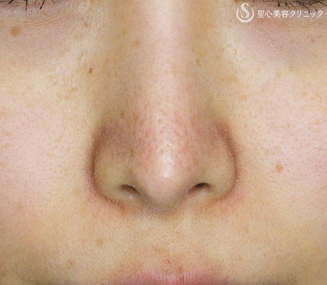 症例写真 術後 プロテーゼによる隆鼻術+小鼻縮小