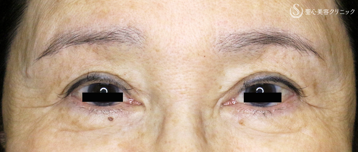 眉下切開法（眉下リフト）_After