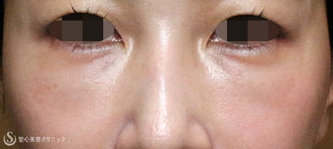 目の下の脂肪取り（経結膜下脱脂法）+プレミアムPRP皮膚再生療法+ヒアルロニダーゼ_Before