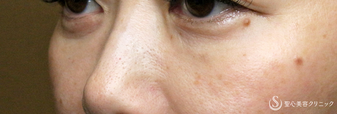 下眼瞼切開術/下眼瞼除皺術/ハムラ法＋プレミアムPRP皮膚再生療法_After