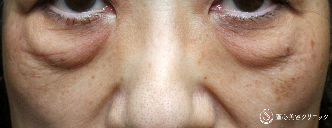 下眼瞼切開術/下眼瞼除皺術/ハムラ法＋プレミアムPRP皮膚再生療法_Before