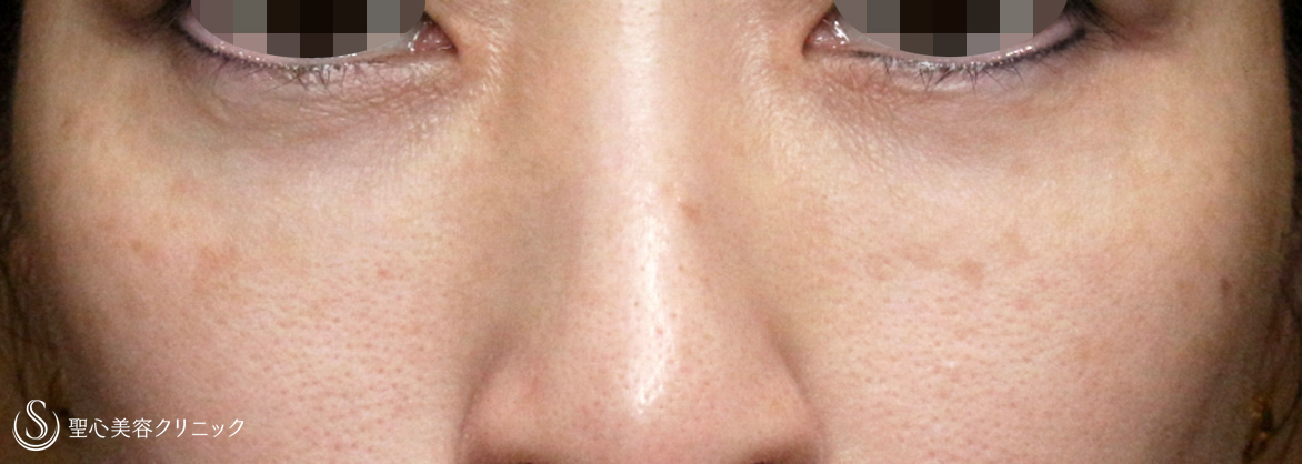 目の下の脂肪取り（経結膜下脱脂法）+プレミアムPRP皮膚再生療法_After
