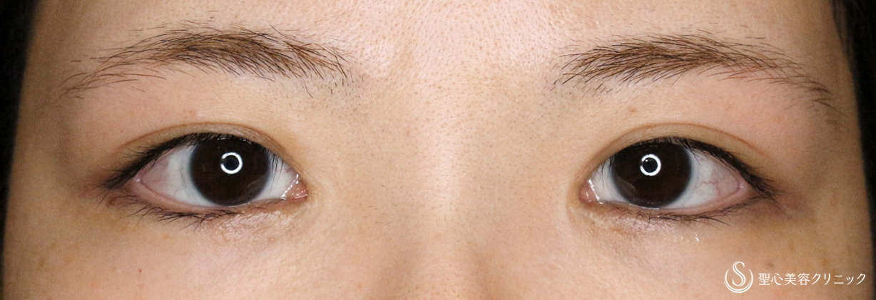 目頭切開+α法（札幌院独自メニュー）_After