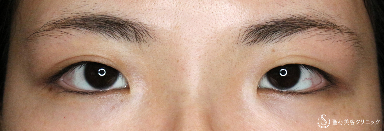 目頭切開+α法（札幌院独自メニュー）_Before