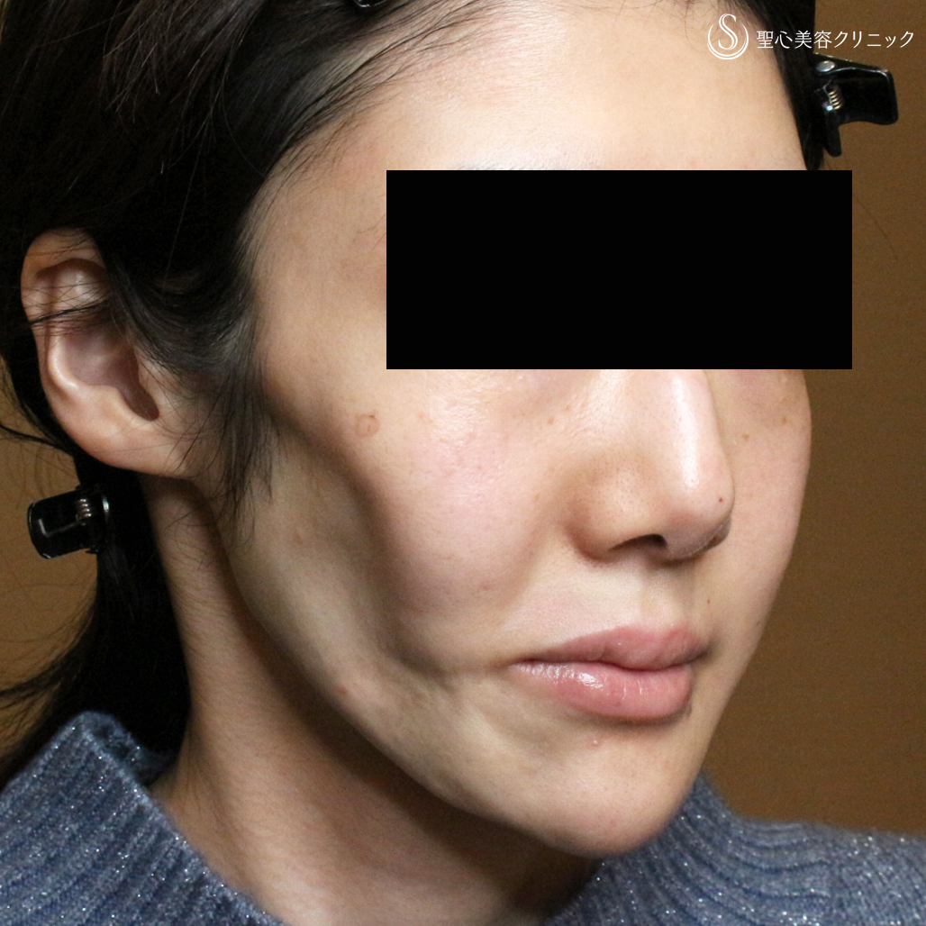 プレミアムPRP皮膚再生療法_Before