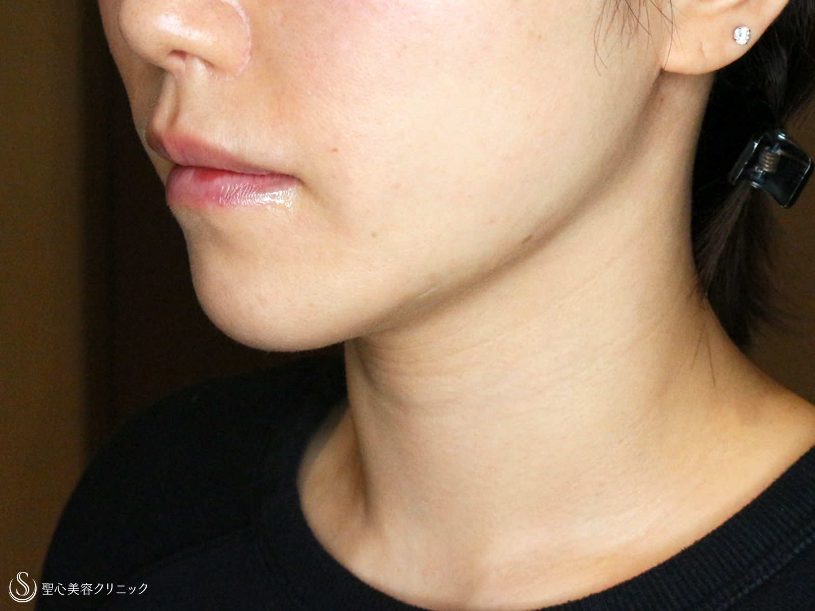 脂肪吸引注射_After