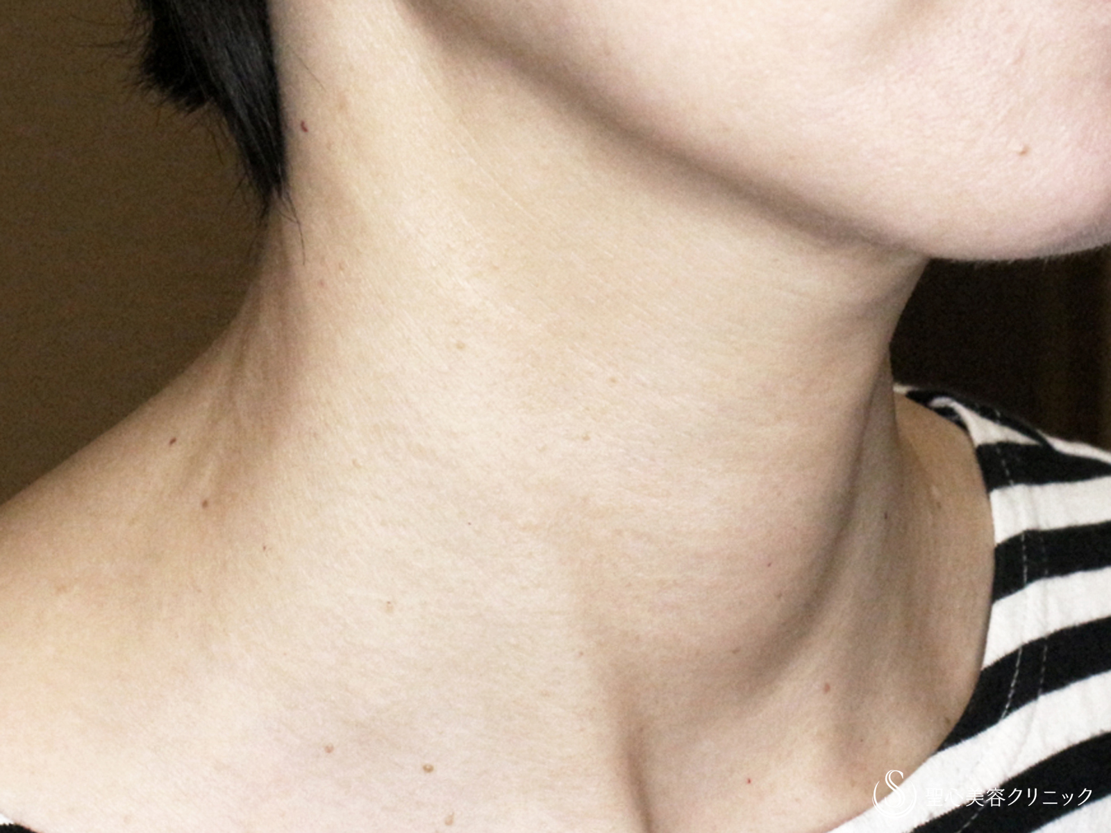 プレミアムPRP皮膚再生療法_After