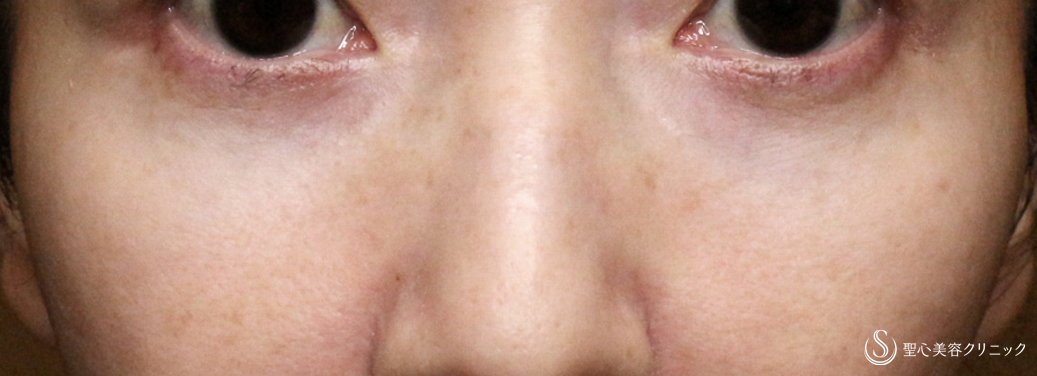 目の下の脂肪取り（経結膜下脱脂法）_After